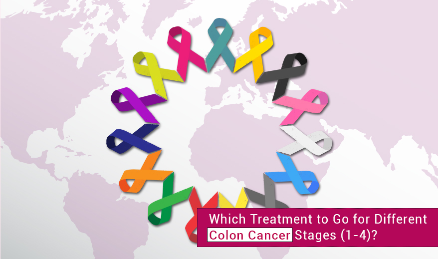 Treatment to Go for Different Colon Cancer Stages 